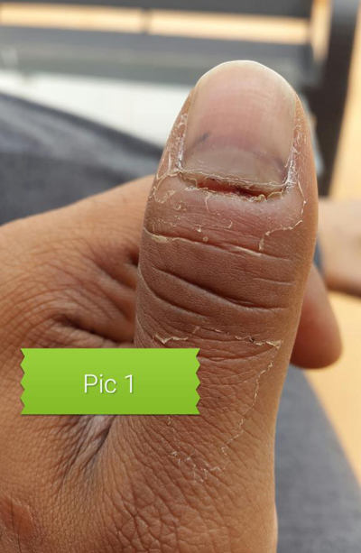 An Atlas of Nail Disorders, Part 5 | Consultant360