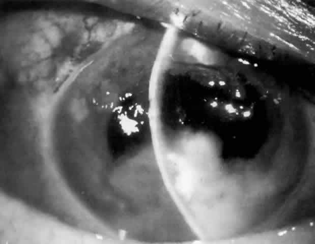 free cataract surgery, blinded after cataract surgery, nandyal free eye camp, blided after eye operation in ap, namndya diocese kurnool district ap, eye patients binded, botched eye operations in ap